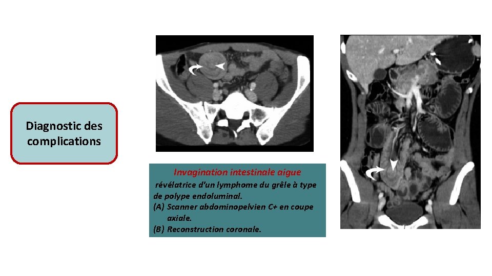 Diagnostic des complications A Invagination intestinale aigue révélatrice d'un lymphome du grêle à type