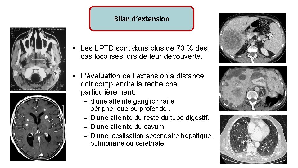 Bilan d’extension § Les LPTD sont dans plus de 70 % des cas localisés