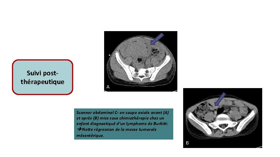 Suivi postthérapeutique A Scanner abdominal C- en coupe axiale avant (A) et après (B)