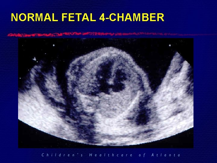 NORMAL FETAL 4 -CHAMBER 