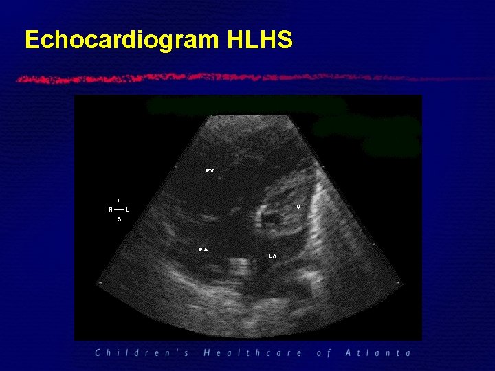 Echocardiogram HLHS 