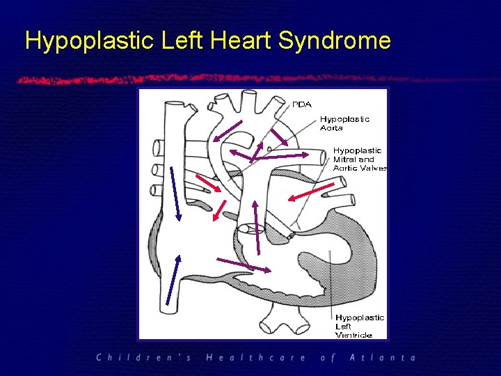 Hypoplastic Left Heart Syndrome 