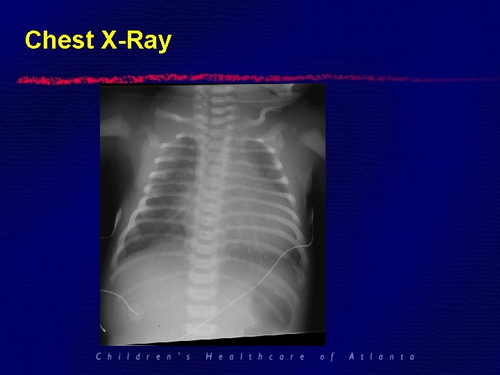 Chest X-Ray 