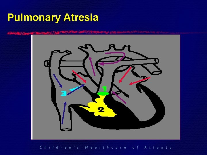 Pulmonary Atresia 
