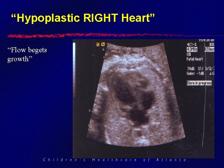 “Hypoplastic RIGHT Heart” “Flow begets growth” 
