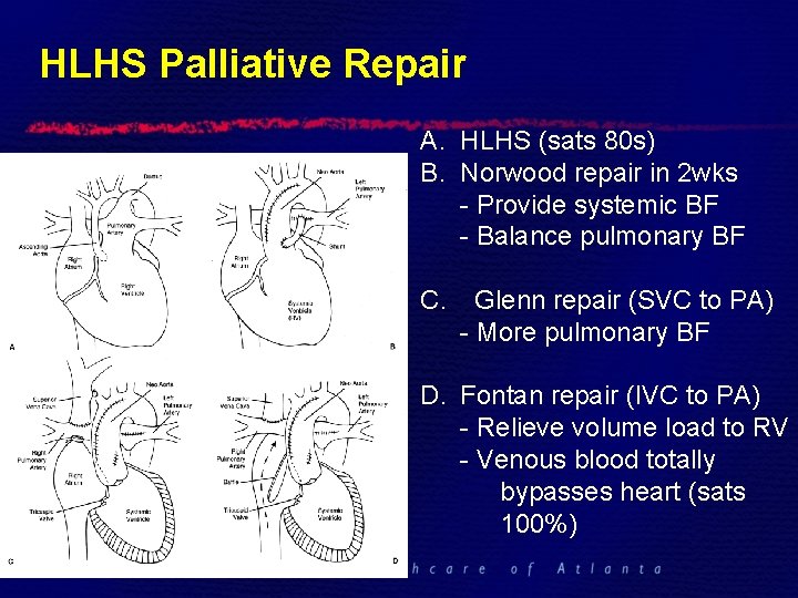 HLHS Palliative Repair A. HLHS (sats 80 s) B. Norwood repair in 2 wks