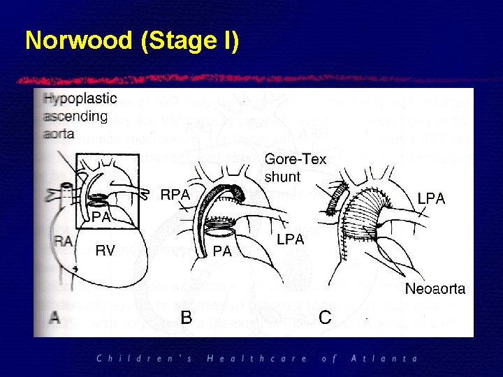 Norwood (Stage I) 