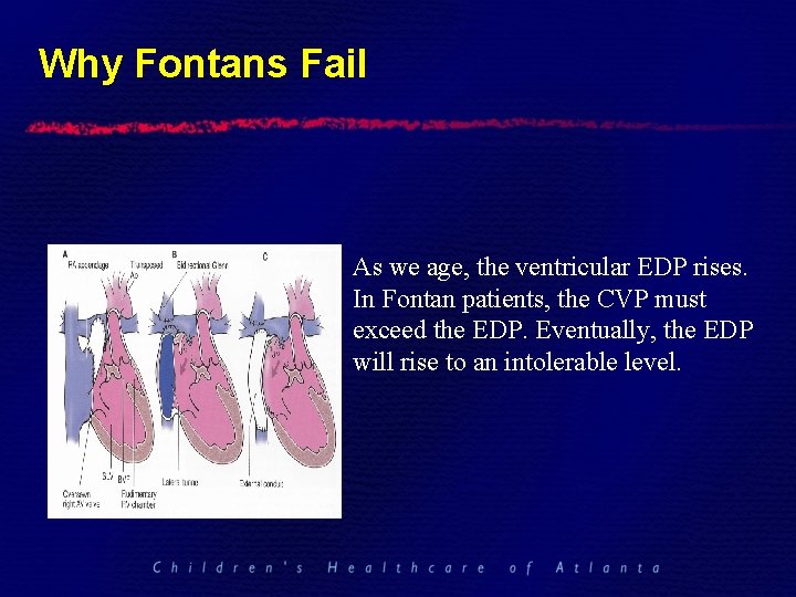 Why Fontans Fail As we age, the ventricular EDP rises. In Fontan patients, the