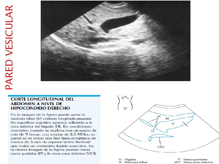 PARED VESICULAR PARED VESICULAR