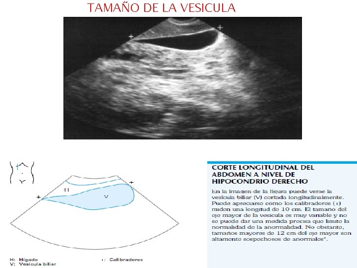 TAMAÑO DE LA VESICULA TAMAÑO DE LA VESICULA