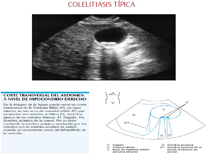 COLELITIASIS TÍPICA COLELITIASIS TÍPICA