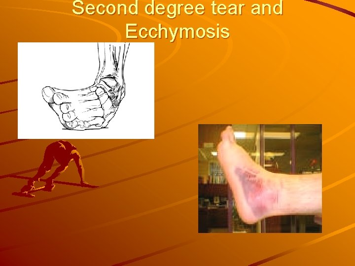 Second degree tear and Ecchymosis 