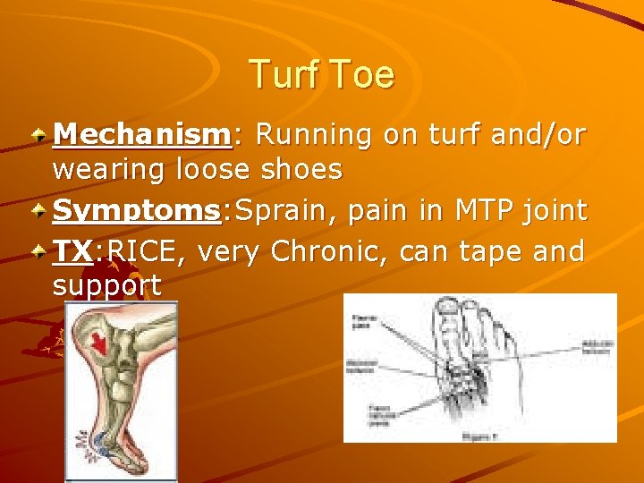 Turf Toe Mechanism: Running on turf and/or wearing loose shoes Symptoms: Sprain, pain in
