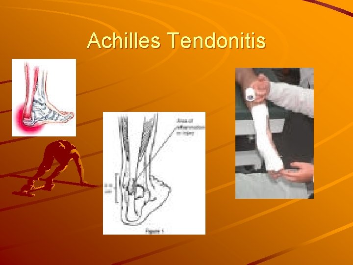 Achilles Tendonitis 