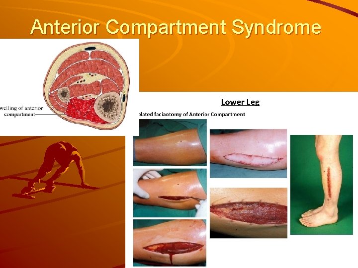 Anterior Compartment Syndrome 