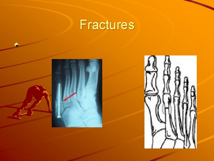 Fractures 