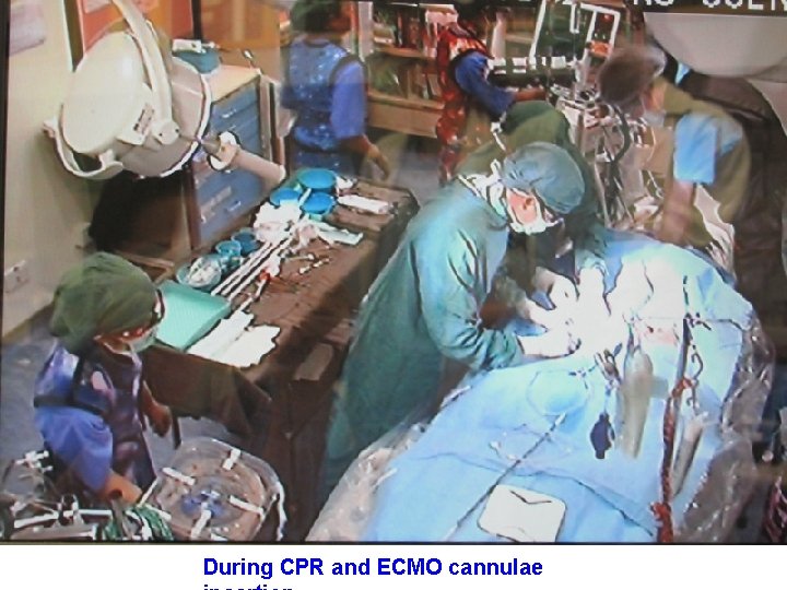 During CPR and ECMO cannulae 