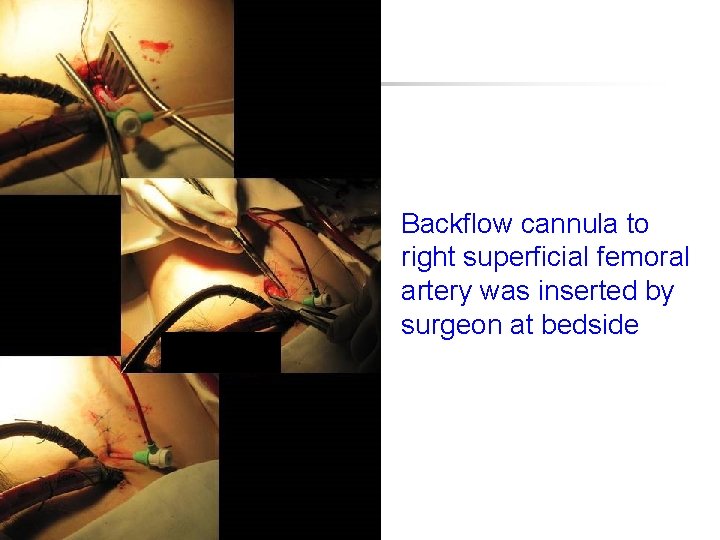 Backflow cannula to right superficial femoral artery was inserted by surgeon at bedside 