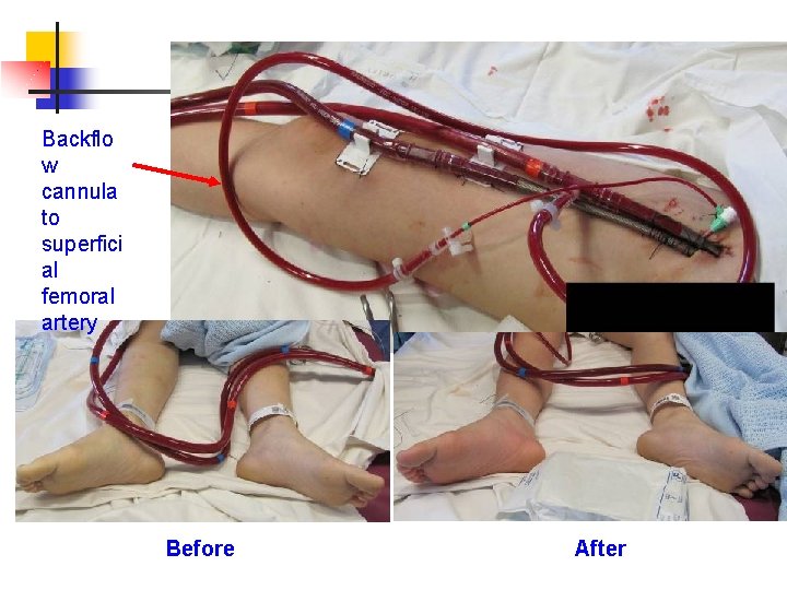 Backflo w cannula to superfici al femoral artery Photos showing backflow cannulae & ECMO
