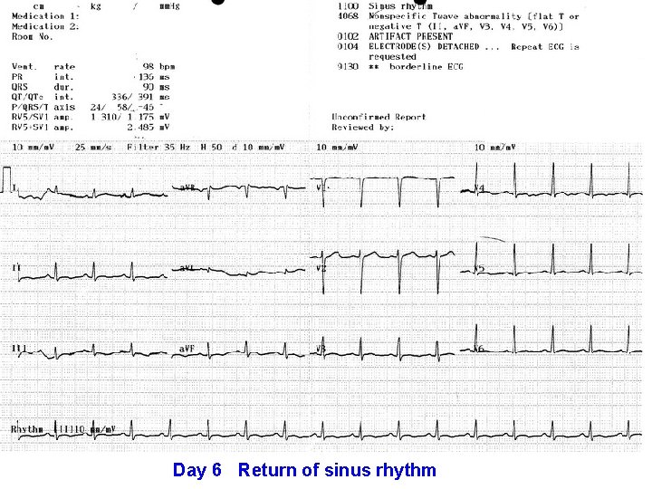 Day 6 Return of sinus rhythm 