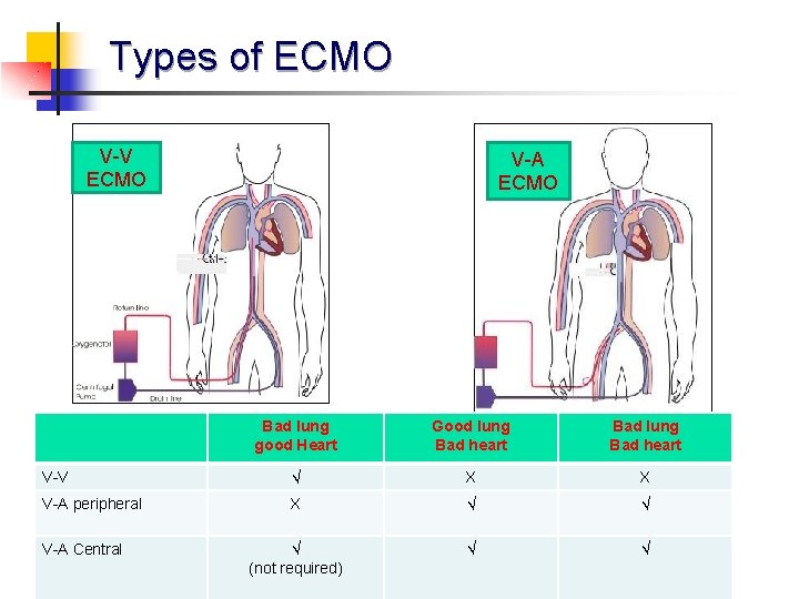 Types of ECMO V-V ECMO V-A ECMO Bad lung good Heart Good lung Bad
