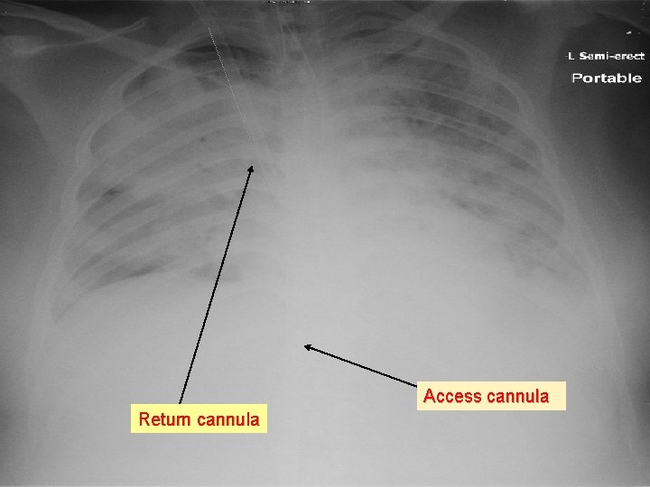 Access cannula Return cannula 