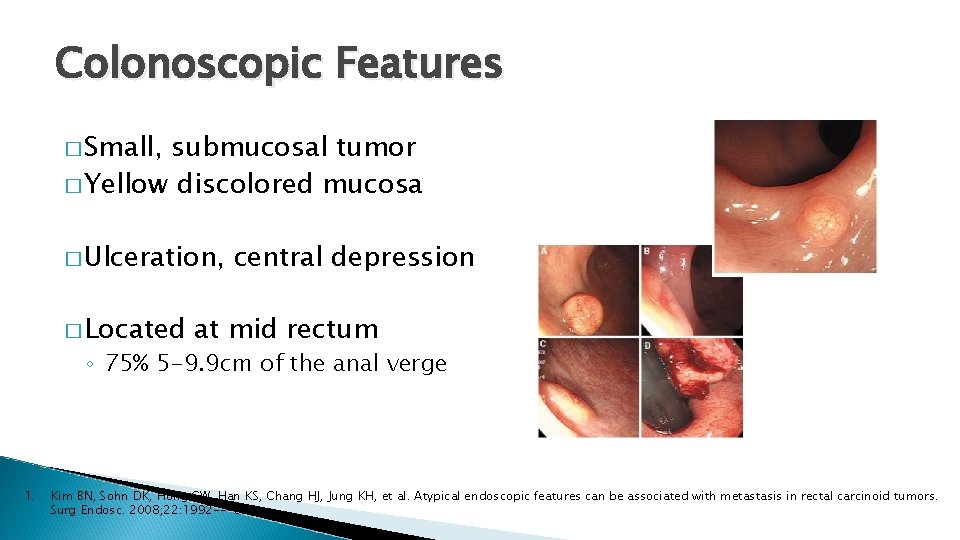 Colonoscopic Features � Small, submucosal tumor � Yellow discolored mucosa � Ulceration, � Located