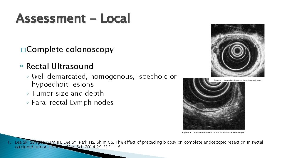 Assessment - Local � Complete colonoscopy Rectal Ultrasound ◦ Well demarcated, homogenous, isoechoic or