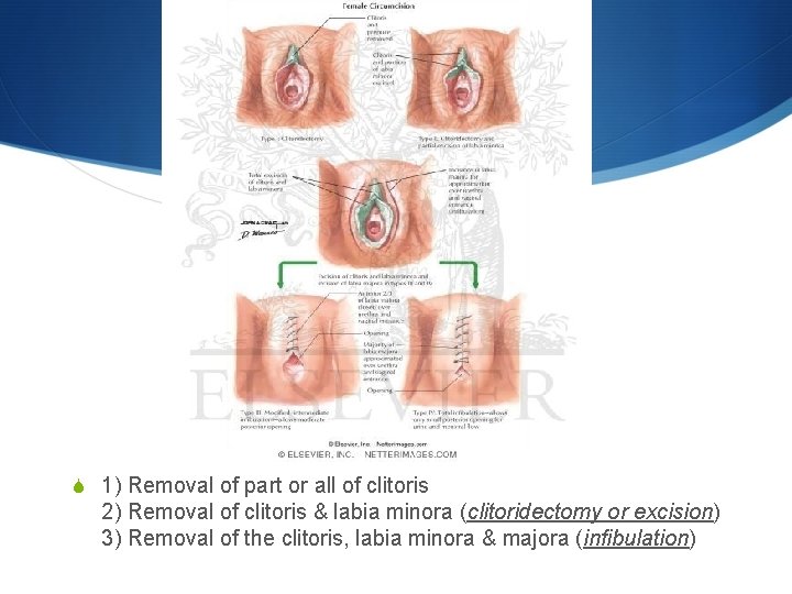 S 1) Removal of part or all of clitoris 2) Removal of clitoris &