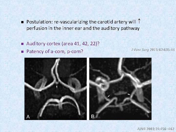 n Postulation: re-vascularizing the carotid artery will perfusion in the inner ear and the