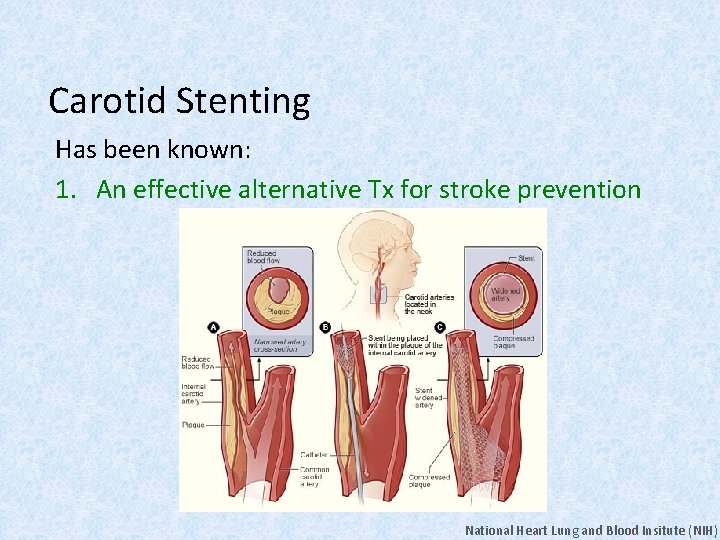 Carotid Stenting Has been known: 1. An effective alternative Tx for stroke prevention National