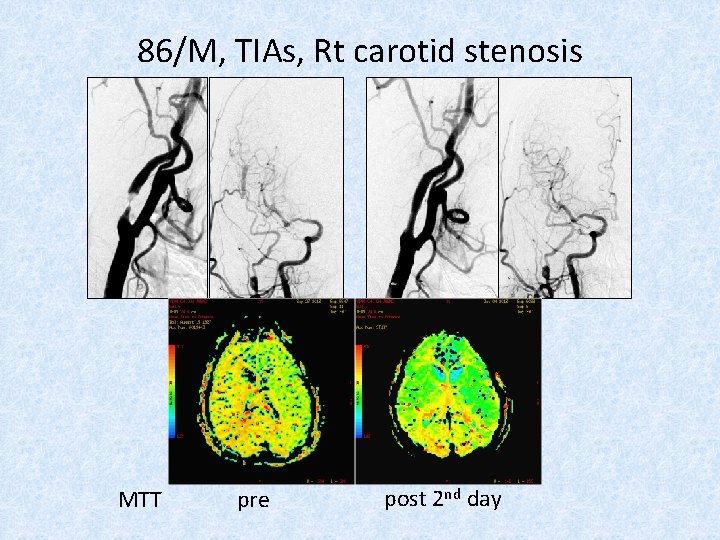 86/M, TIAs, Rt carotid stenosis MTT pre post 2 nd day 