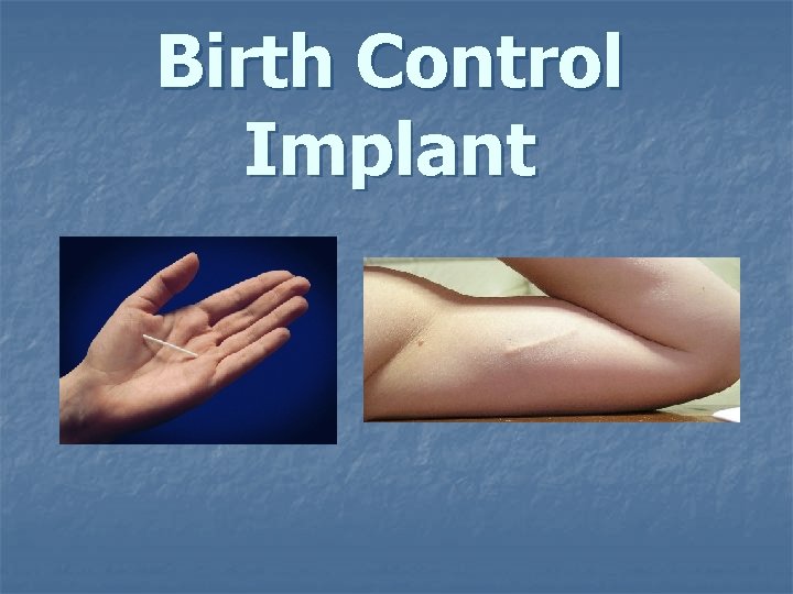 Birth Control Implant Birth Control Implant