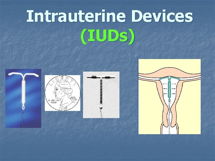 Intrauterine Devices (IUDs) Intrauterine Devices (IUDs)