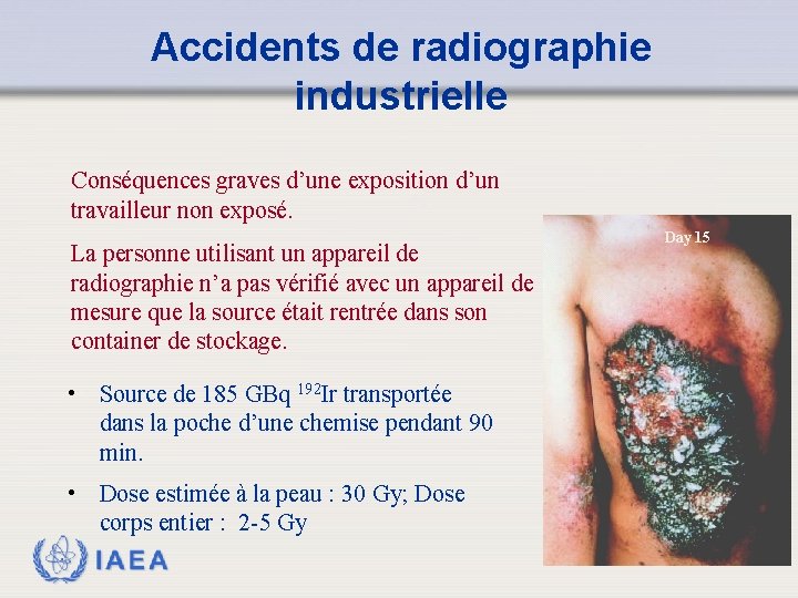 Accidents de radiographie industrielle Conséquences graves d’une exposition d’un travailleur non exposé. La personne