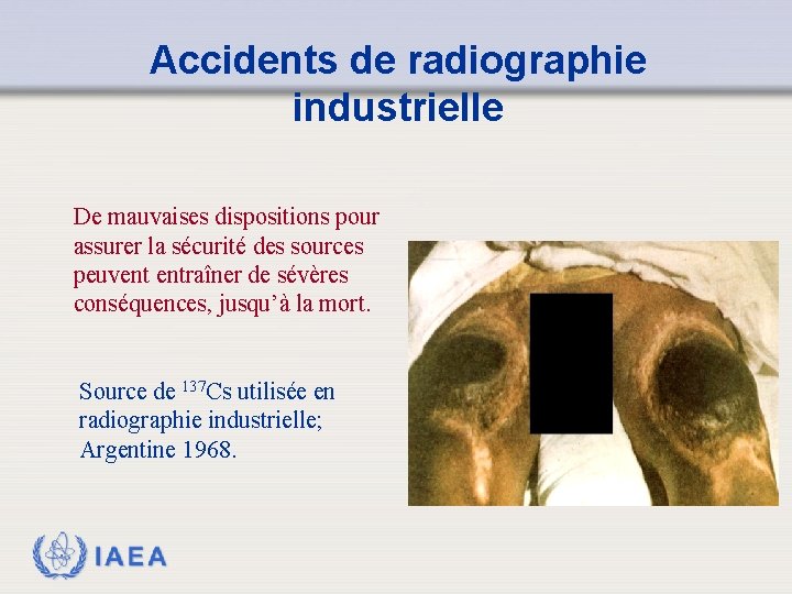 Accidents de radiographie industrielle De mauvaises dispositions pour assurer la sécurité des sources peuvent