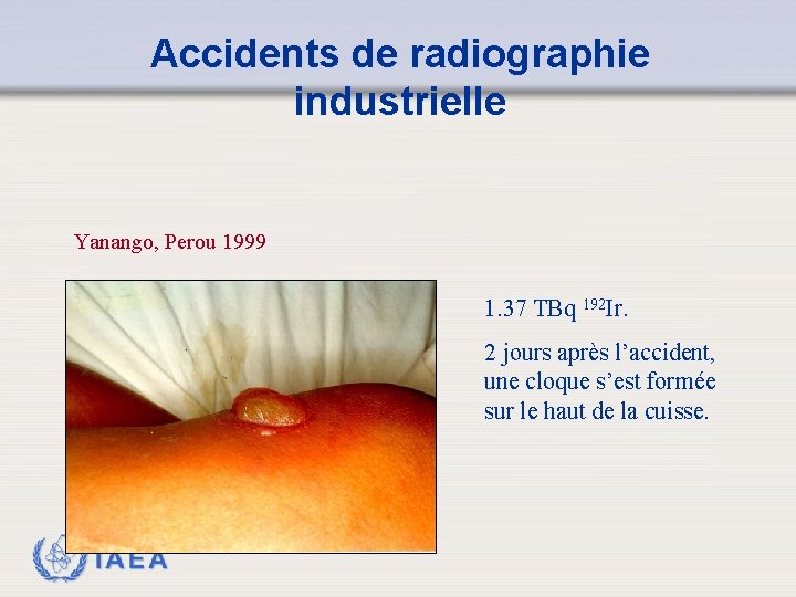 Accidents de radiographie industrielle Yanango, Perou 1999 1. 37 TBq 192 Ir. 2 jours