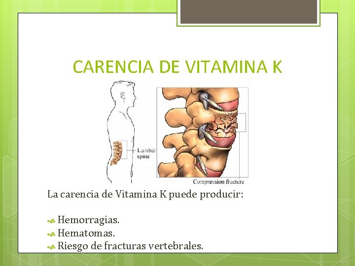 CARENCIA DE VITAMINA K La carencia de Vitamina K puede producir: Hemorragias. Hematomas. Riesgo