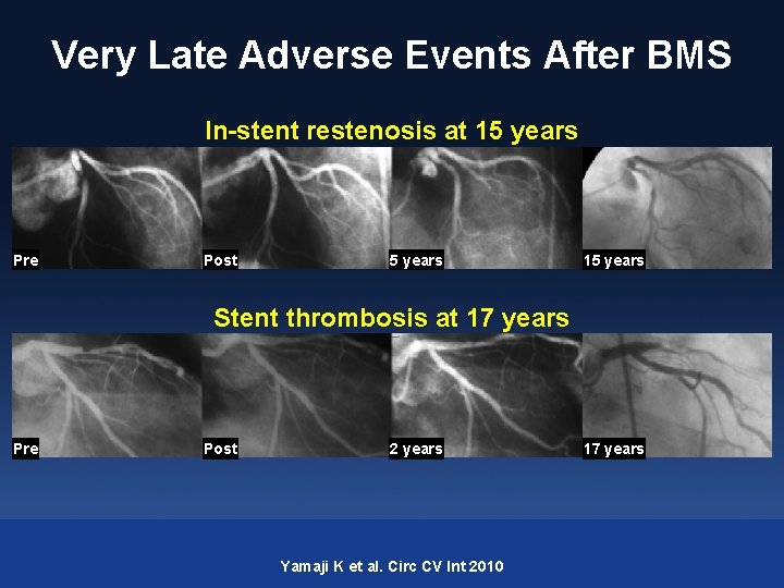 Very Late Adverse Events After BMS In-stent restenosis at 15 years Pre Post 5