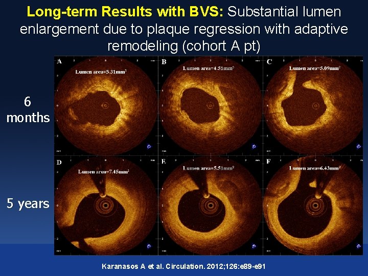 Long-term Results with BVS: Substantial lumen enlargement due to plaque regression with adaptive remodeling