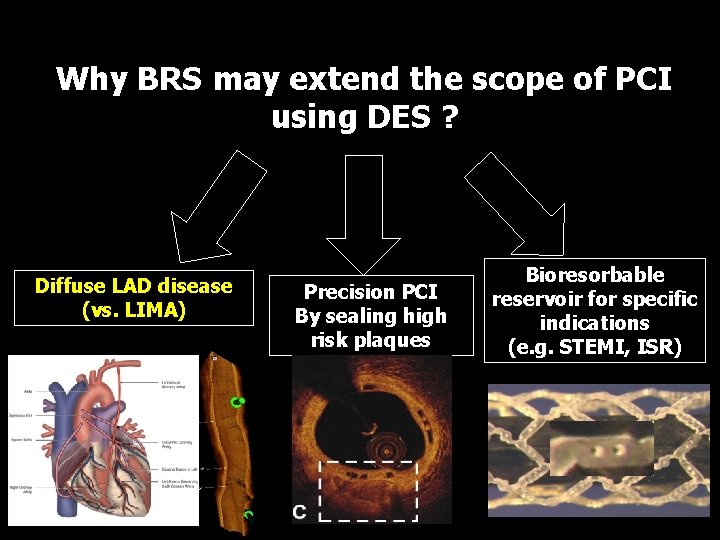 Why BRS may extend the scope of PCI using DES ? Diffuse LAD disease