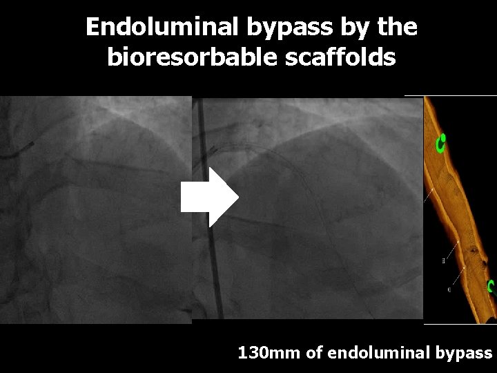 Endoluminal bypass by the bioresorbable scaffolds LCx Absorb 2. 5 x 28 mm Absorb