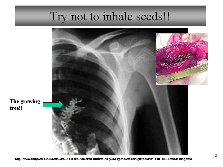 Try not to inhale seeds!! The growing tree!! http: //www. dailymail. co. uk/news/article-1169861/Shocked-Russian-surgeons-open-man-thought-tumour--FIR-TREE-inside-lung. html