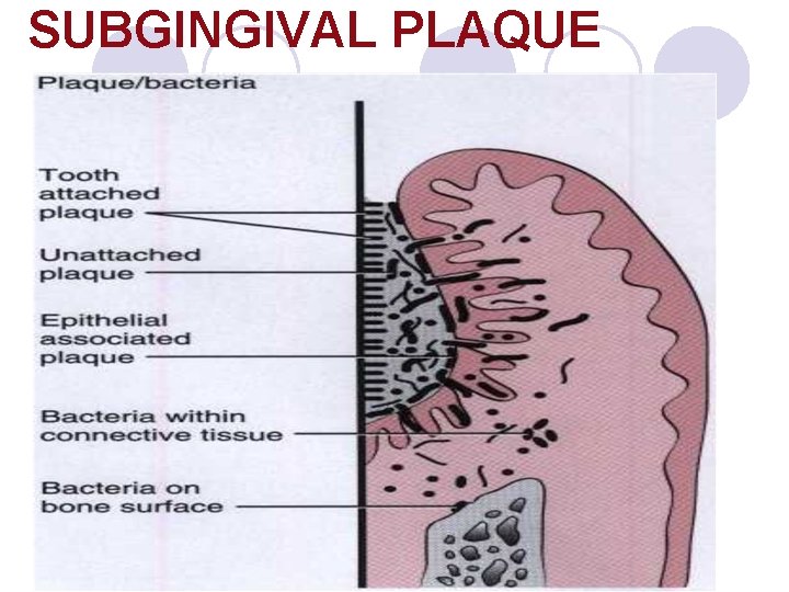SUBGINGIVAL PLAQUE SUBGINGIVAL PLAQUE