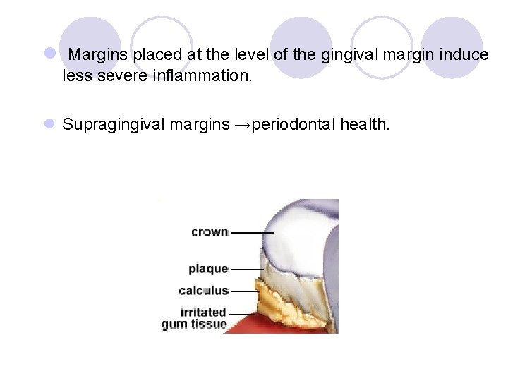 l Margins placed at the level of the gingival margin induce less severe inflammation. l Margins placed at the level of the gingival margin induce less severe inflammation.