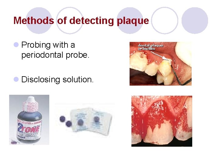 Methods of detecting plaque l Probing with a periodontal probe. l Disclosing solution. Methods of detecting plaque l Probing with a periodontal probe. l Disclosing solution.