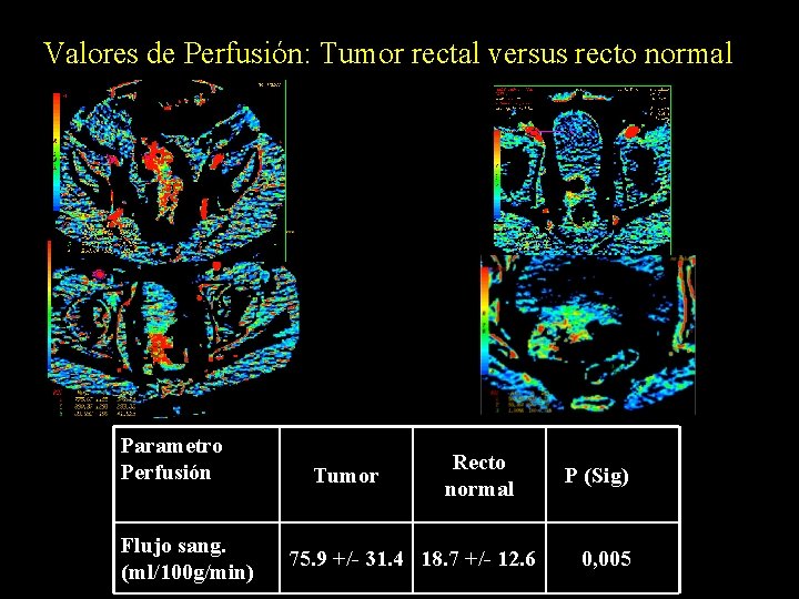 Valores de Perfusión: Tumor rectal versus recto normal Parametro Perfusión Flujo sang. (ml/100 g/min)