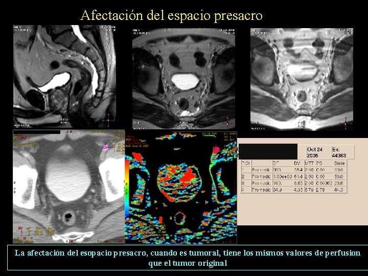 Afectación del espacio presacro La afectación del esopacio presacro, cuando es tumoral, tiene los