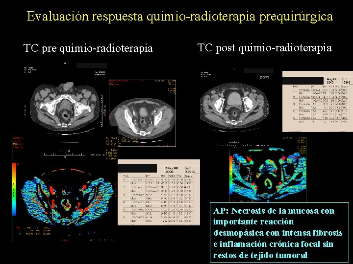 Evaluación respuesta quimio-radioterapia prequirúrgica TC pre quimio-radioterapia TC post quimio-radioterapia AP: Necrosis de la
