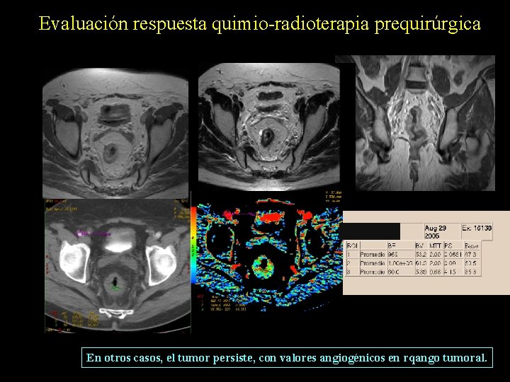 Evaluación respuesta quimio-radioterapia prequirúrgica En otros casos, el tumor persiste, con valores angiogénicos en